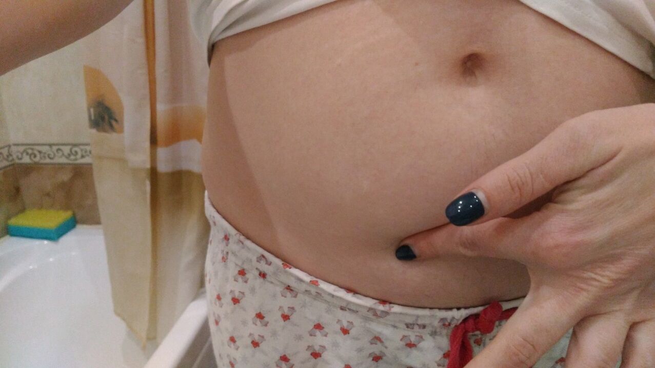 Signos de infección por helmintos por experiencia personal.