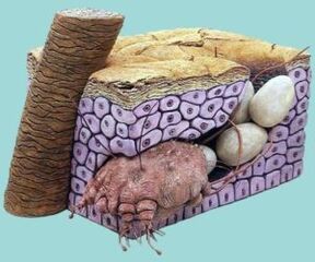 Ácaro de la sarna, que se manifiesta como picazón en la piel, a veces en forma de manchas y enrojecimiento.